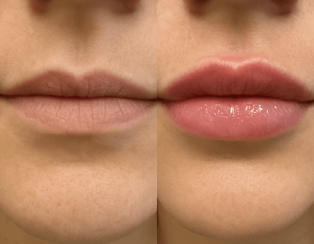 prf lips treatment prf lips treatment